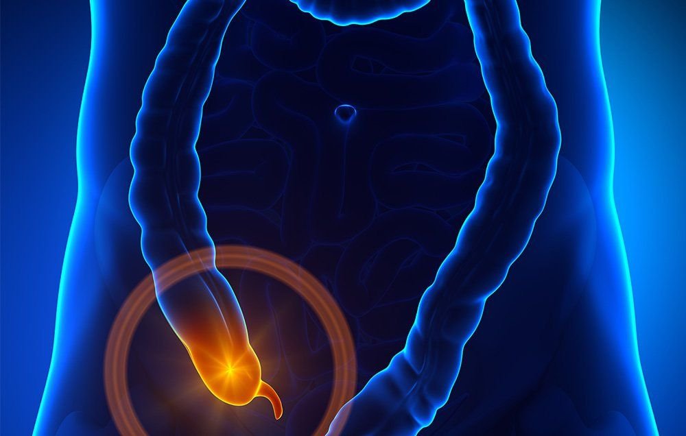 Inflammation of the appendix due to the accumulation of pus