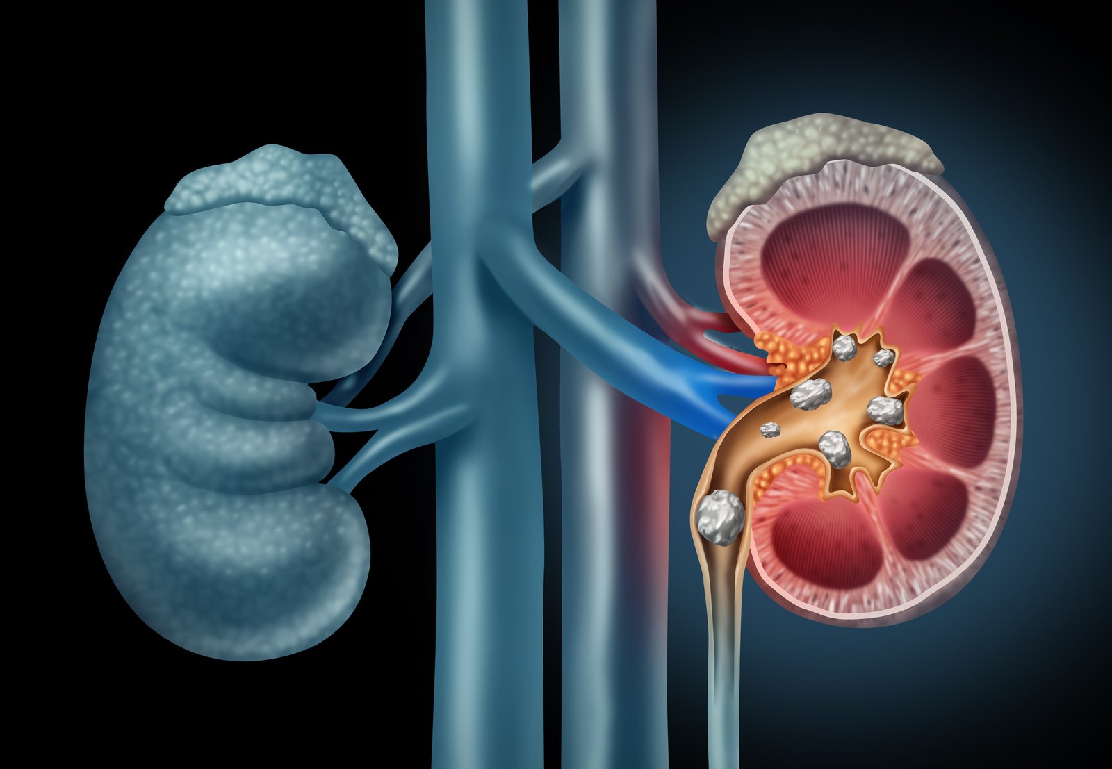 Deposits of minerals and salts that harden within the kidney